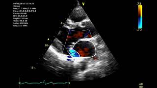 Echocardiographic assessment of the mitral valve [upl. by Cruickshank902]