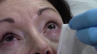 Blephex Blepharitis Treatment at Face amp Eye [upl. by Nais335]