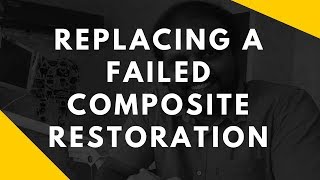 Replacing A Failed Composite Restoration  Dr Rajeeve S Pillai [upl. by Ema]