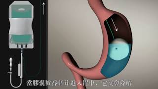 Elipse Intragastric Balloon [upl. by Atilal]