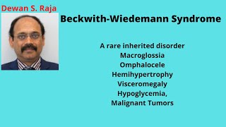 BeckwithWiedemann Syndrome [upl. by Eenel642]