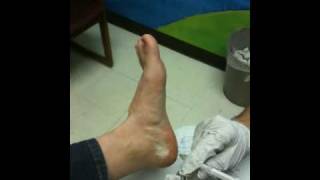 Placing a Cortisone Injection into the Plantar Fascia [upl. by Stilwell]