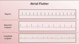 Intro to EKG Interpretation  Overview of Tachyarrhythmias [upl. by Iramat347]