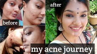 acne peel ചെയ്തപ്പോൾ എനിക്ക് സംഭവിച്ചത്acne journeymy experience acneproneskinitsmeaparna [upl. by Eelnayr]