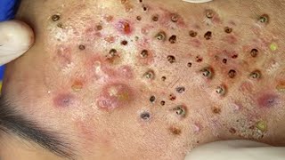 Big Cystic Acne Blackheads Extraction Blackheads amp Milia Whiteheads Removal Pimple Popping  2313 [upl. by Andromada]