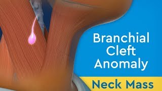 Neck Mass Branchial Cleft Anomaly [upl. by Ahusoj]