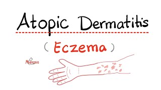 Atopic Dermatitis Eczema  with a mnemonic  Dermatology [upl. by Ynffit858]