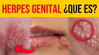 Herpes genital síntomas causas transmisión y tratamientos efectivos [upl. by Anielram878]