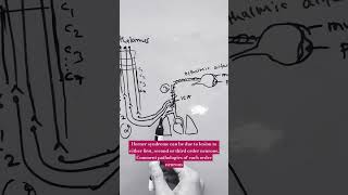 HORNER SYNDROME  lateral medullary syndrome lung apex tumor internal carotid dissection [upl. by Eelidnarb]