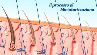 Alopecia Androgenetica il processo di Miniaturizzazione [upl. by Katharyn]