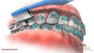 Life with Braces  Brushing amp Flossing [upl. by Aseela]