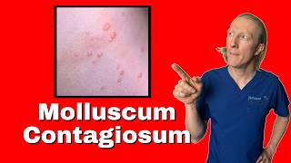 Molluscum Contagiosum causes diagnosis and treatments [upl. by Birdie577]