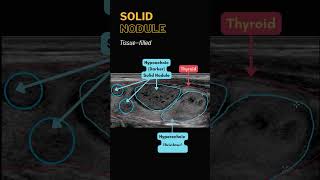 Thyroid Nodule Ultrasound  Cystic Solid Complicated Calcifications [upl. by Pine]