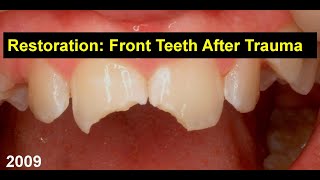 5 Min Case Restoration of Front Teeth after Trauma [upl. by Thorner22]