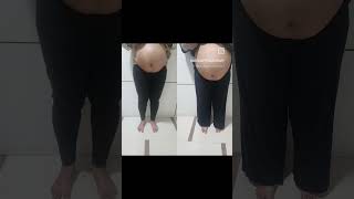 Are you suffering from Diastasis Recti or umblical hernia we are here to help Arogya physiotips [upl. by Whitehouse]