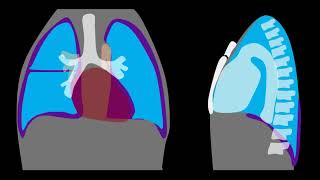 Pneumothorax Explained by Prometheus Lionhart MD [upl. by Marcie954]