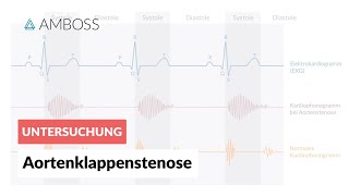 Aortenklappenstenose  Herzgeräusch  AMBOSS Video [upl. by Eenor855]