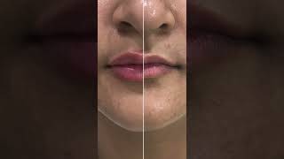 💋✨ Lip fillers skincare dermatologist skincareroutine [upl. by Doykos]