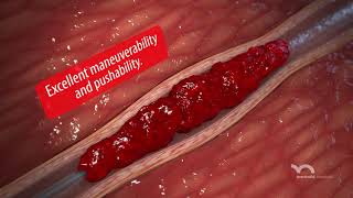 DClot HD Mechanical Thrombectomy System [upl. by Ahsiekram]