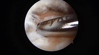 Posterior Ankle Arthroscopy Debridement of Os Trigonum Removal SFISM [upl. by Ettenim]