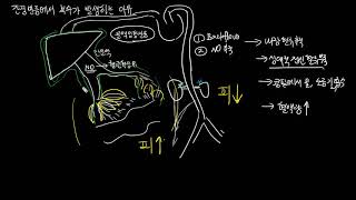 간경변증에서 복수가 발생하는 이유 [upl. by Nnylirej]