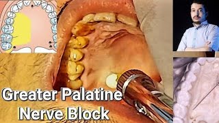 Local Anesthesia Greater Palatine Nerve Block Technique greater Palatine nerve block [upl. by Laerol]