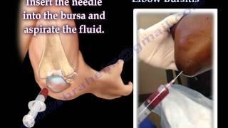 Aspiration Of Elbow Bursitis  Everything You Need To Know  Dr Nabil Ebraheim [upl. by Sari]