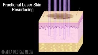 Traditional versus Fractional Laser Skin Resurfacing Procedure Animation [upl. by Funch]