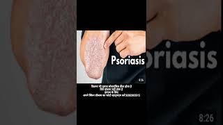 Psoriasis cream Psoriasisbestcream [upl. by Yevrah218]