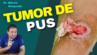 ABSCESSO tumor de pus pode dar febre após drenagem  Dr Márcio Responde [upl. by Acissaj]