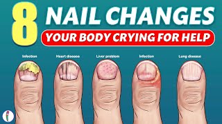 Nail signs of Disease  Nail pitting  Finger clubbing  Signs of anemia  Terrys nails [upl. by Ettenyar185]