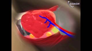 Minimally Invasive Total Thyroidectomy Video [upl. by Erica]