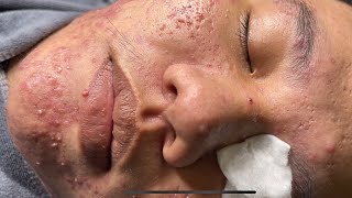 Blackheads amp Pimples Pore Removal New 2024FULL  Acne Treatment With Bo Nguyễn Spa [upl. by Hnad]