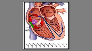 72 Phân biệt cơn AVNRT và Orthodromic AVRT [upl. by Enninaej96]