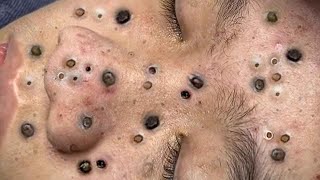 Big Cystic Acne Blackheads Extraction Blackheads amp Milia Whiteheads Removal Pimple Popping  1213 [upl. by Ecirtnuahs]