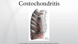 Costochondritis [upl. by Hirst]