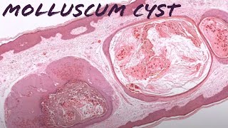 Molluscum quotCystquot cystic molluscum contagiosum pathology dermpath dermatology dermatopathology [upl. by Raama]