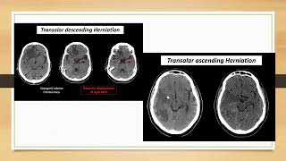 Brain herniation [upl. by Valer]