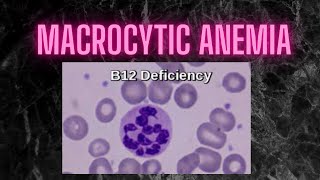 macrocytic anemia diagnosis Practical points [upl. by Ahsaekal]