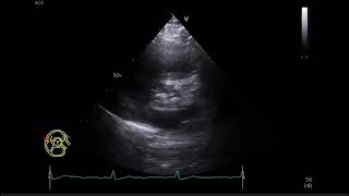 Aortic Stenosis  Transtoracic Echocardiography  Estenose aórtica  Ecocardiografia Transtorácica [upl. by Lein579]