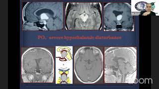 Craniopharyngioma [upl. by Rawley]