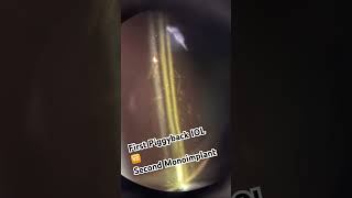 Piggyback IOL VS Monoimplant IOL [upl. by Elylrac354]