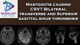 Mastoiditis causing CSVT Bilateral transverse and Superior sagittal sinus thrombosis [upl. by Notselrahc]