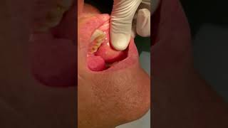 Parotid gland sialolithiasis dentist hospital dentalstudent students dentistryworld [upl. by Viviene]