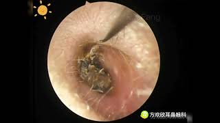 Ear wax removalFungus cleaning Ear canal cleaningEndoscopic Ear Treatment（外耳道清理，真菌感染清理）20230813 [upl. by Gagne]