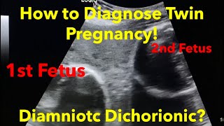 Twin Pregnancy  Diamniotic Dichorionic how to diagnose  easy steps [upl. by Anav324]