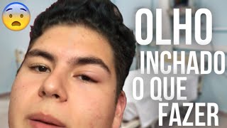 Está com o olho inchado saiba o que fazer [upl. by Htaras482]