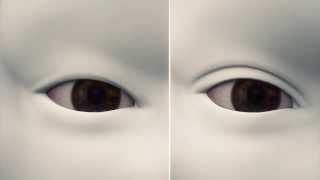 How double eyelid surgery works [upl. by Huan419]