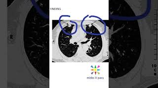 Medicine CT finding rheumatoid necrobiotic nodules thoracic image guess viva [upl. by Odnumde]