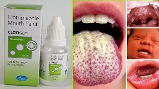 Clotrimazole mouth paint How to apply Candid mouth paint  Nuforce mouth paint everytime healthcare [upl. by Dareen]